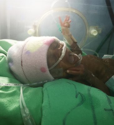 Baby W, transferred to Kijabe from a closed government hospital.